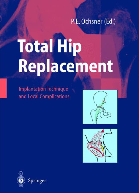 Weitere Ansicht: Total Hip Replacement