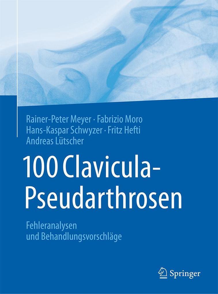 Produktbild: 100 Clavicula-Pseudarthrosen | Rainer-Peter Meyer, Fabrizio Moro, Hans-Kaspar Schwyzer, Fritz Hefti