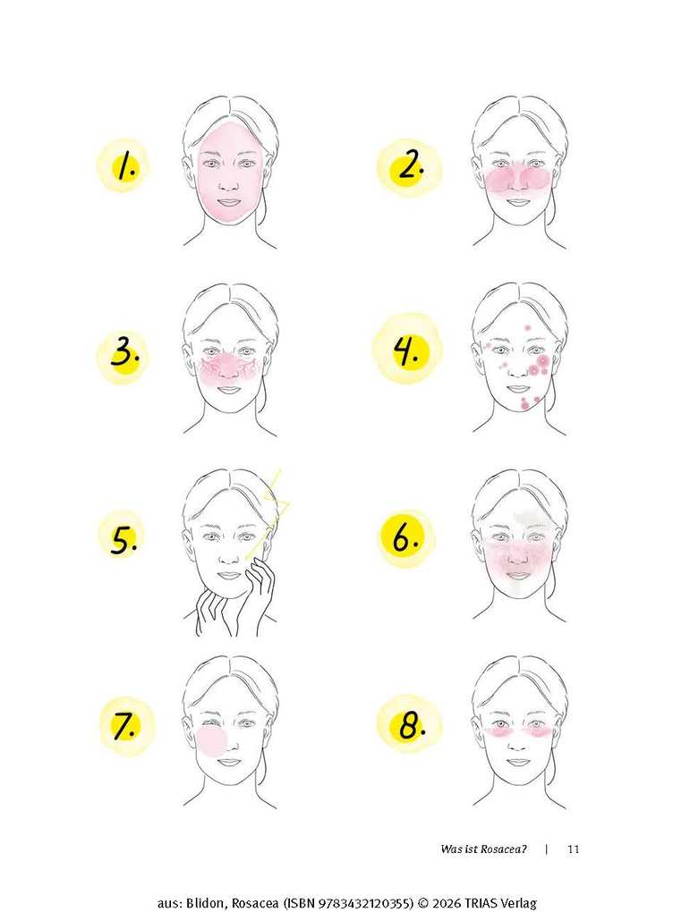 Weitere Ansicht: Rosacea | Elke Blidon